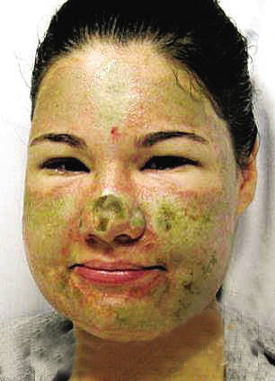 女子为成媒体红人自导自演泼硫酸毁容组图