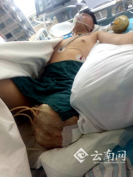 云南三兄妹同时被钢筋戳翻 老大截肢妹妹肝肺破裂 云南三兄妹同时被钢筋戳翻 老大截肢妹妹肝肺破裂