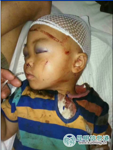 三岁男童家中玩耍被倒塌的铁门框砸中受重伤 三岁男童家中玩耍被倒塌的铁门框砸中受重伤