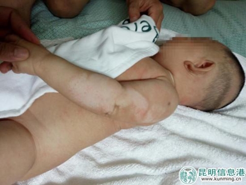 孩子被烫伤的皮肤已经结痂脱落。家属供图