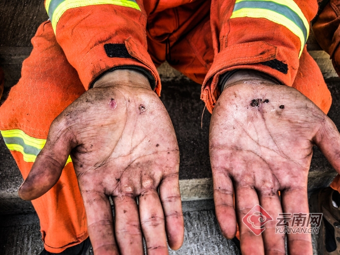 森林消防队员的手磨起了水泡 满东飞 王刘金 刘勃飞 摄 森林消防队员的手磨起了水泡 满东飞 王刘金 刘勃飞 摄