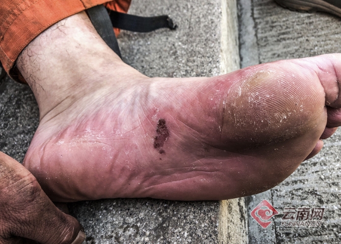 森林消防队员的脚磨起了水泡 满东飞 王刘金 刘勃飞 摄 森林消防队员的脚磨起了水泡 满东飞 王刘金 刘勃飞 摄