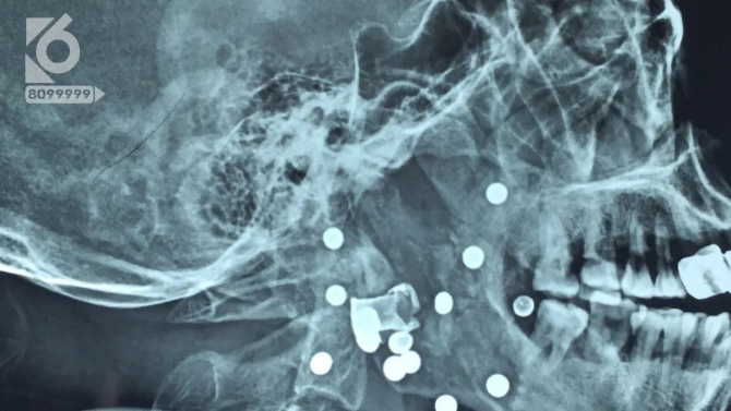 男子脸部被射15.5颗钢珠，竟说是“自己走火”？