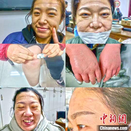 核酸采样手“冻成馒头”,这些医护人员说……