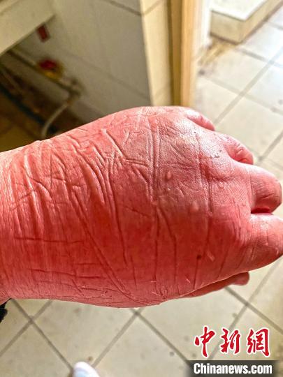 医疗队员被冻伤的手。图片由陆军军医大学士官学校附属医院提供 医疗队员被冻伤的手。图片由陆军军医大学士官学校附属医院提供