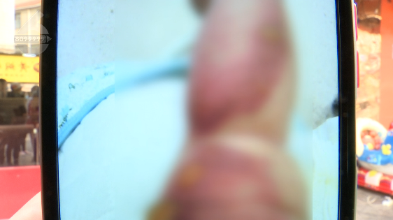 母婴店洗澡,8月婴儿被烫成二度烧伤