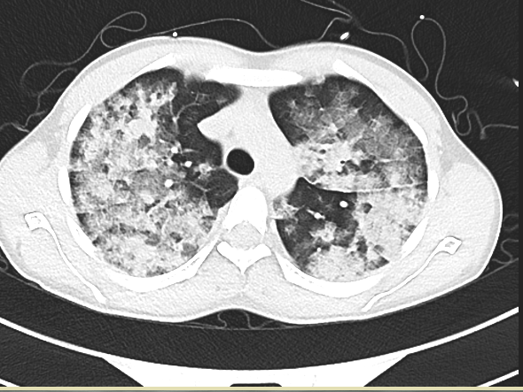 出现高反休息下就好了?当心危及生命!(大理大学第一附属医院供图)